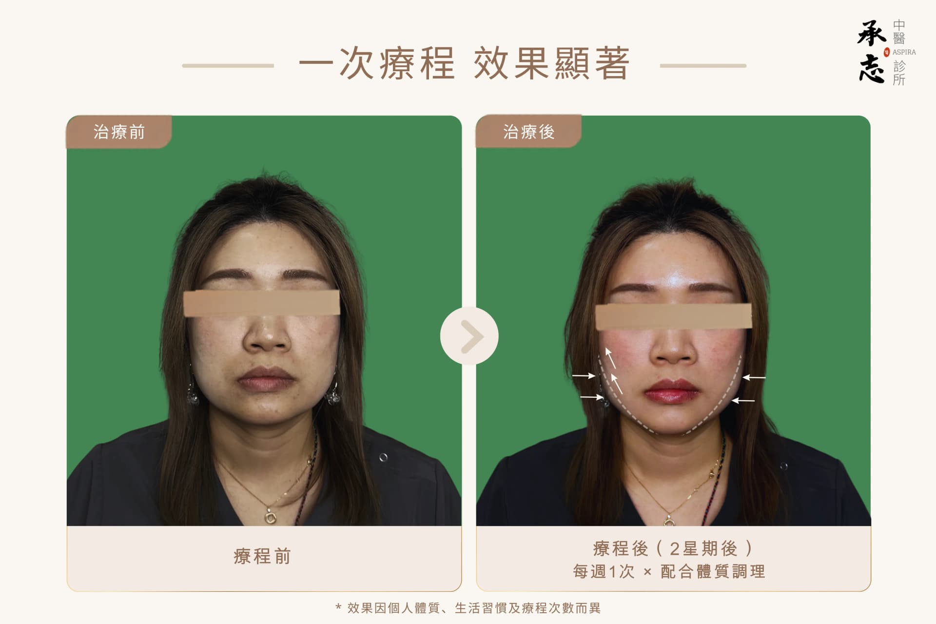 女士美顏針療程前後對比