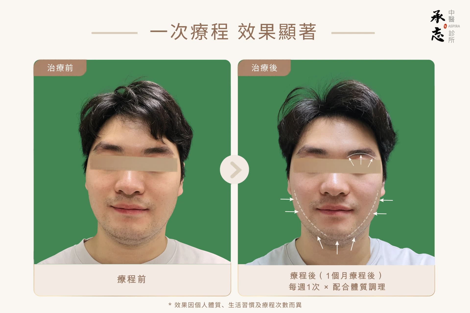 男士美顏針療程前後對比